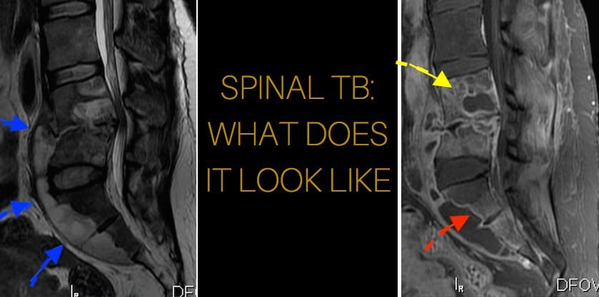 mri-infection-spinal-tb-appearance-tuberculosis-radiology-radedasia