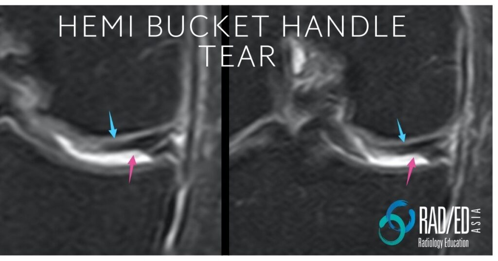 mri knee hemi bucket handle tear radiology education asia