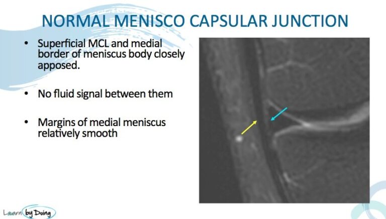 mri knee menisco capsular separation normal appearance radiology education asia