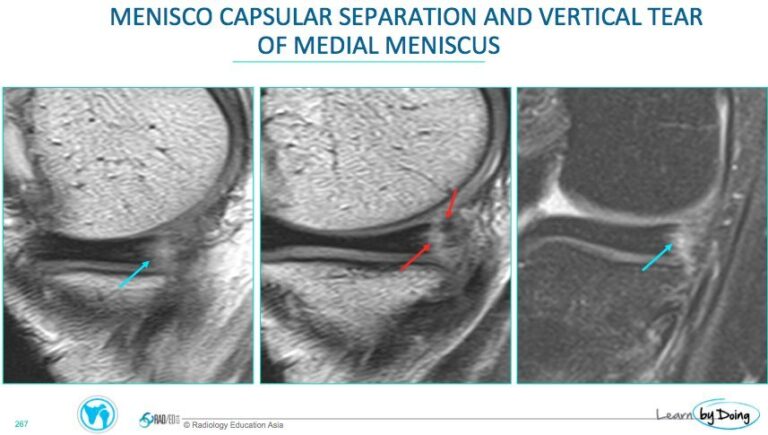 mri knee menisco capsular separation vertical tear meniscus radiology education asia