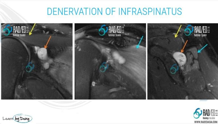 mri-shoulder-denervation-parsonage-turner-syndrome-infraspinatus-supraspinatus-paralabral-cyst-suprascapular-spinoglenoid-notch-anatomy-radiology-education-asia-radedasia