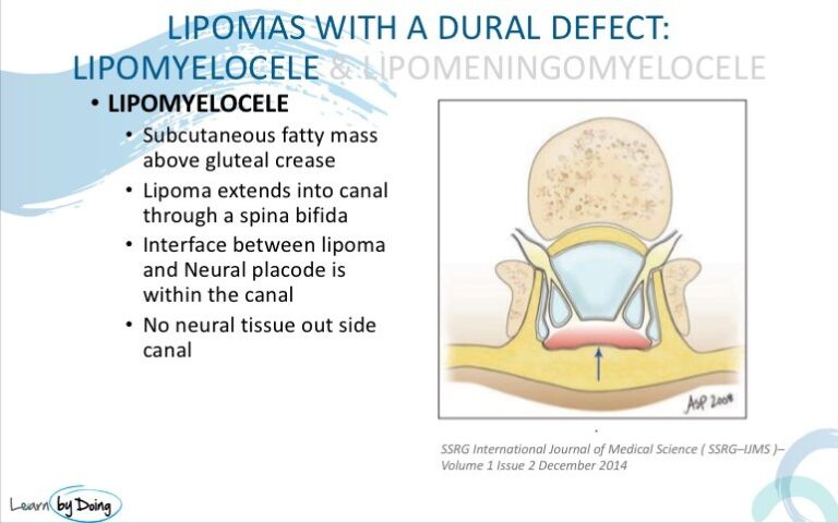 mri spinal dysraphism lipomyelocele radiology education asia