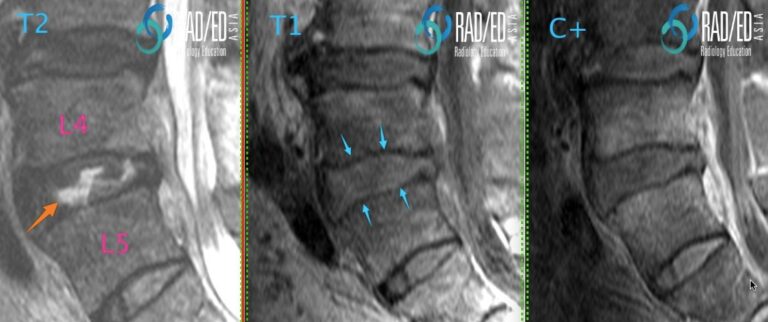 mri spine discitis endplate comparison sequences radiology education asia