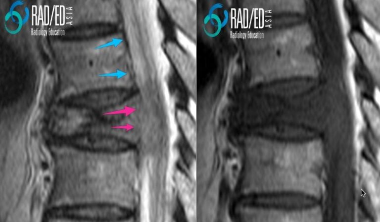 mri spine pathological fracture radiology education asia loss of cortex