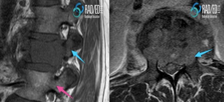 mri spine pathological fracture radiology education asia pedicle involved