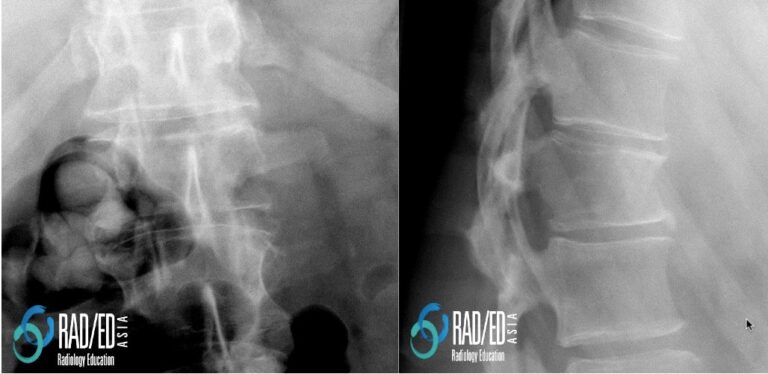 mri spine pathological fracture radiology education asia xray