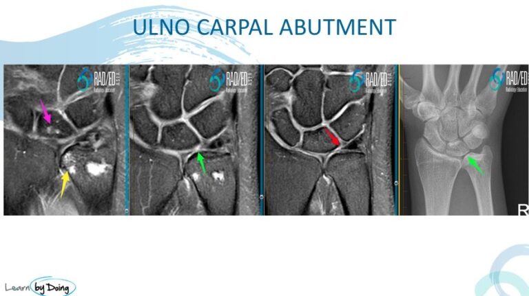 mri wrist ulnar abutment variance radiology education asia