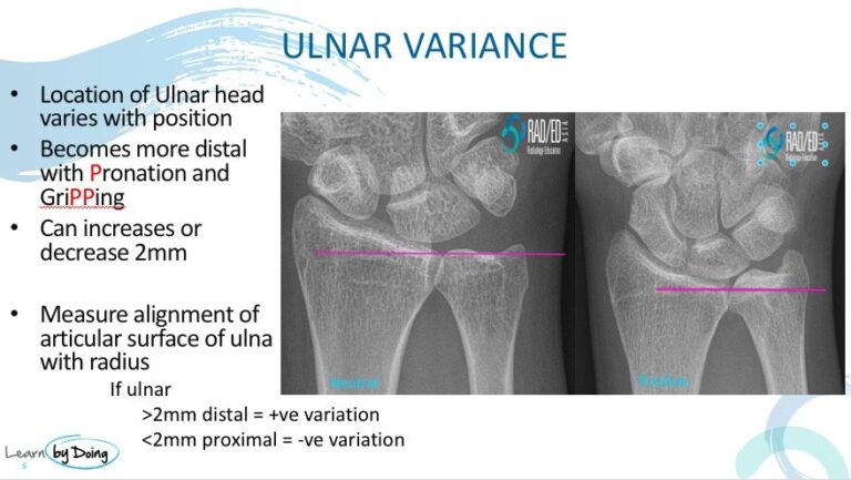 mri wrist ulnar variance radiology education asia