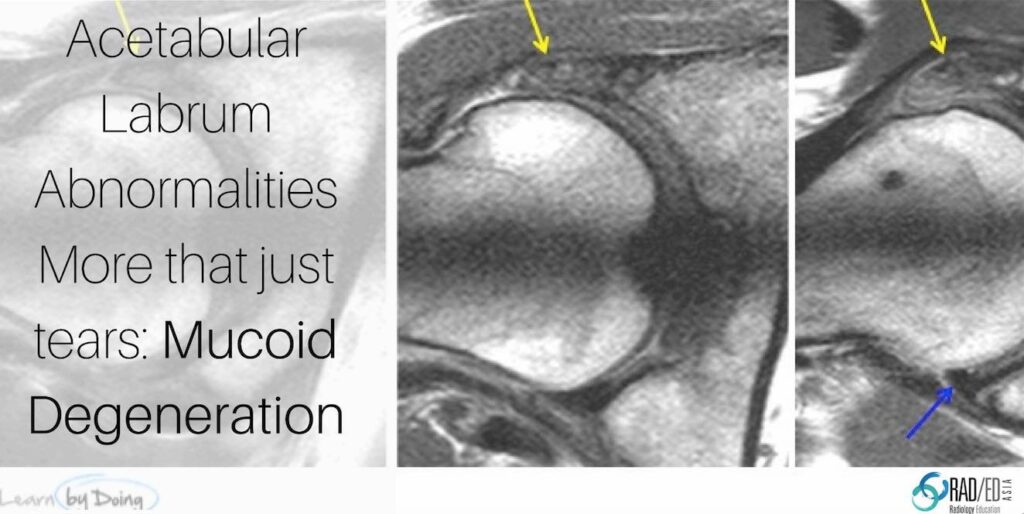 mucoid-degeneration-hip-labrum