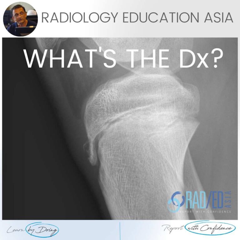 osgood schlatter xray radiology radedasia