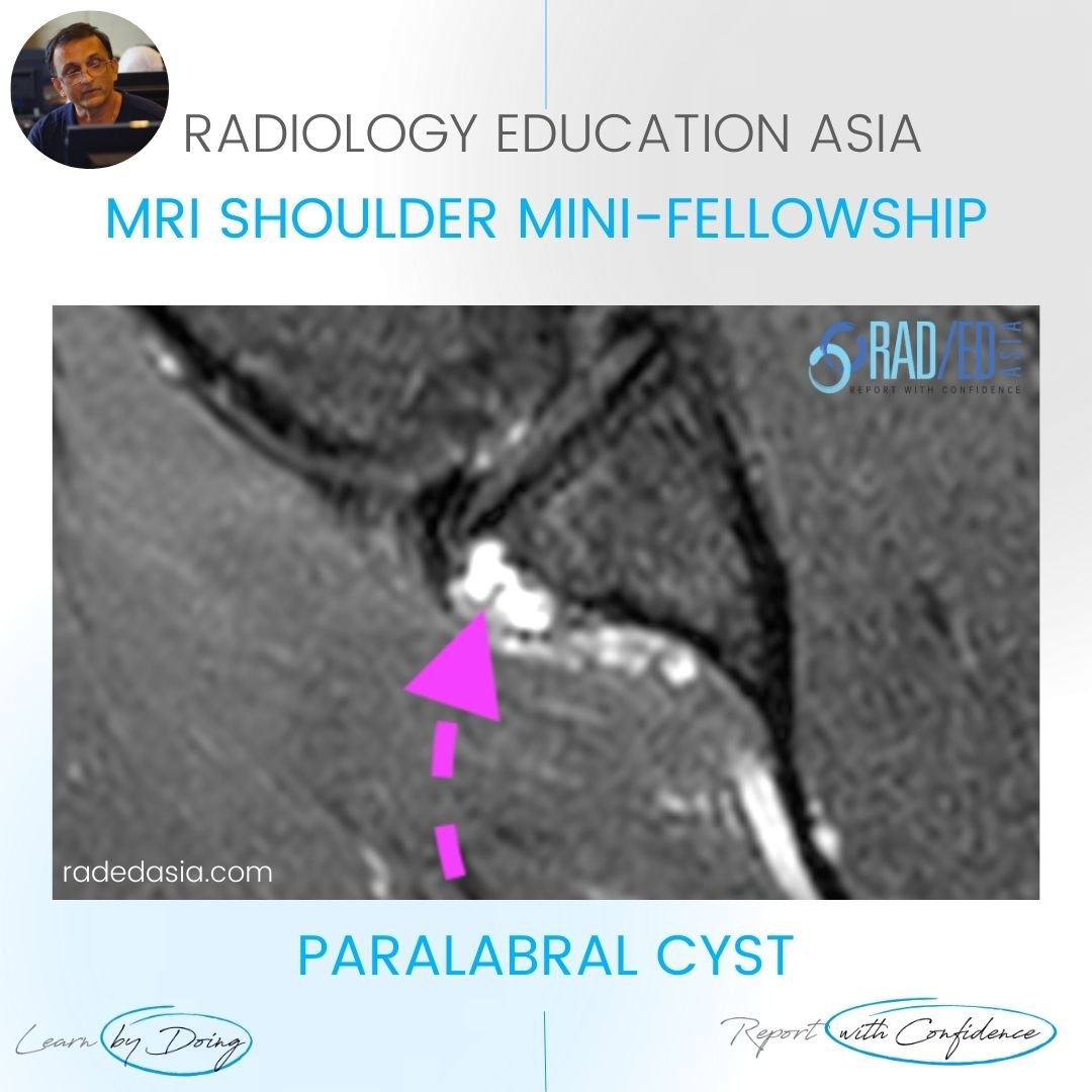 paralabral cyst shoulder labrum labrum mri radedasia