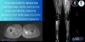 polyarteritis nodosa myopericarditis myositis mri pet ct coronary angiogram imaging radedasia