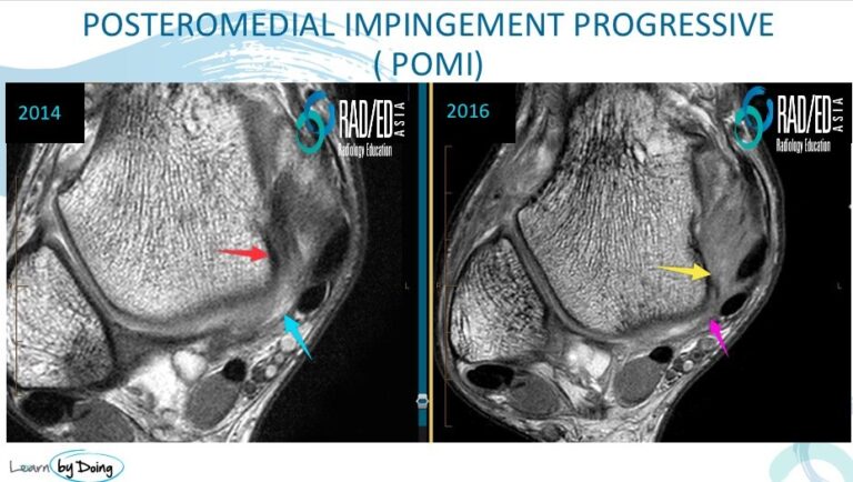 postero medial ankle impingement pomi posteromedial gutter radiology education asia