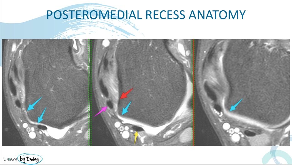 postero medial ankle impingement posteromedial gutter pomi normal radiology education asia