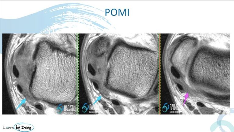 postero medial ankle impingement posteromedial gutter pomi normal radiology education asia