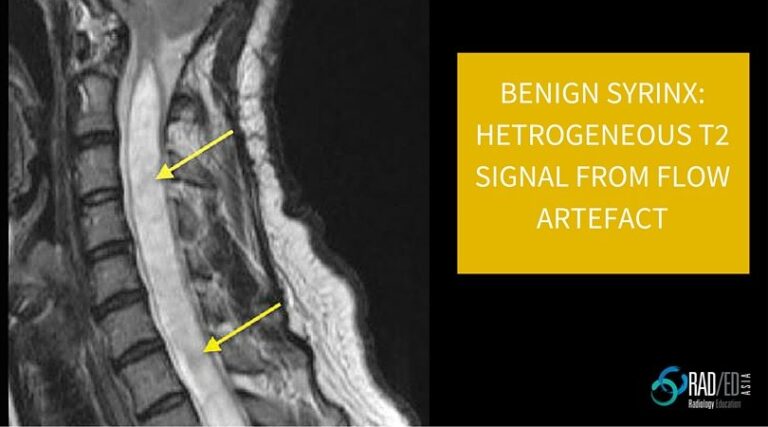syrinx mri flow artefact radebdasia