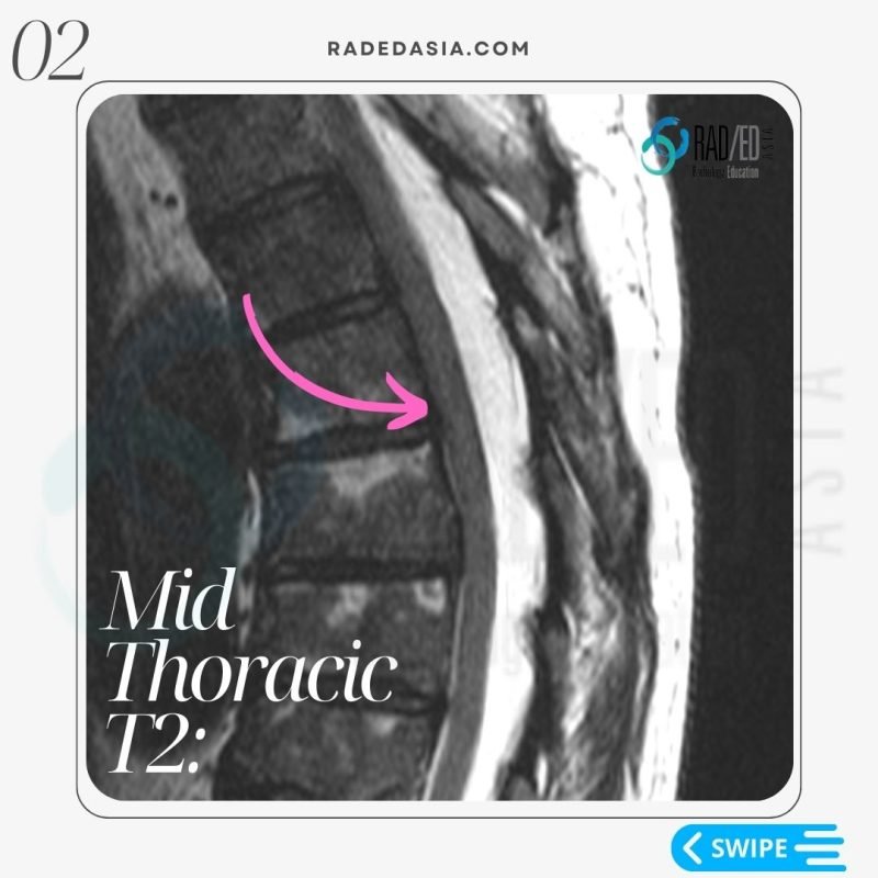 radiology-thoracic-epidural-lipomatosis-spinal-spine-mri-radedasia