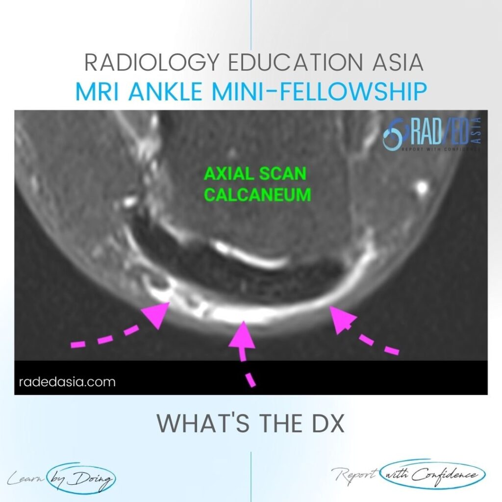 retroachilles bursa bursitis mri radiology ankle