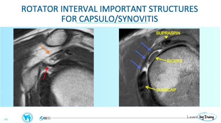 rotator interval synovitis mri