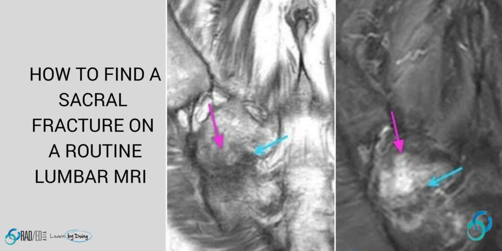 sacral fracture lumbar mri radiology education asia