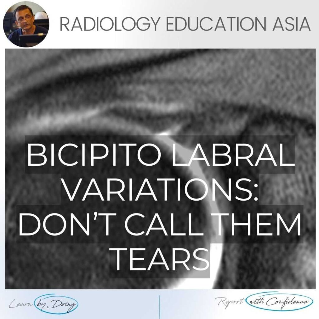 shoulder labrum mri variant anatomy bicipito labrum complex radedasia