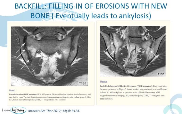 sij sacroileitis backfill chronic radiology education asia mri