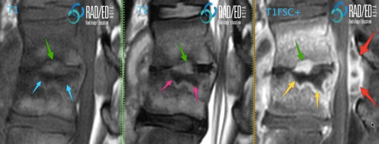 spine discitis bone changes infarct and granulation RADIOLOGY EDUCATION ASIAtissue