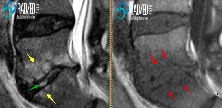 spine discitis endplate oedema radedasia 