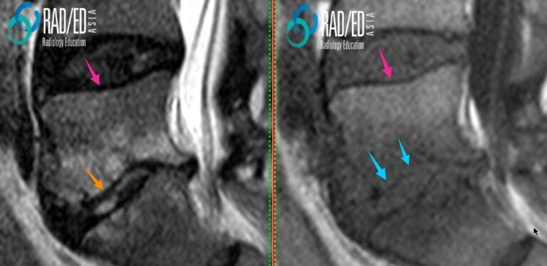 spine mri discitis endplate radiology education asia