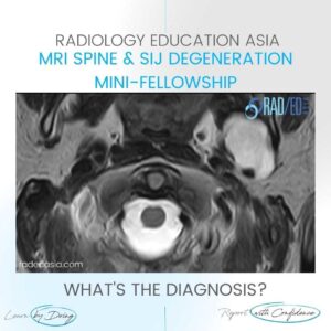 spine mri incidental findings parotid mass