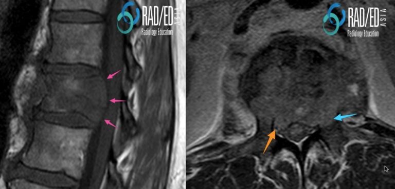 mri spine pathological fracture radiology education asia