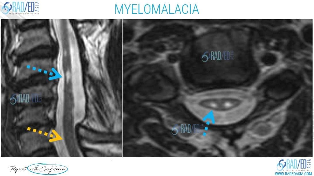 spondylotic-myelomalacia-mri-radiology-education-radedasia-image 2