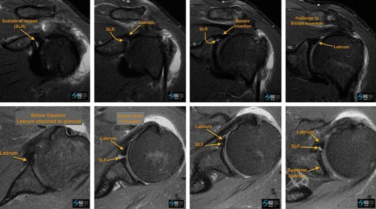 sub-labral-foramen-recess-radedasia