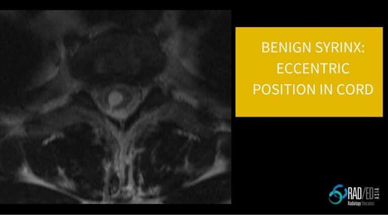 syrinx mri eccentric radedasia