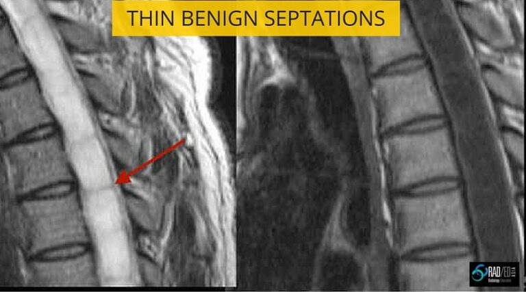 syrinx mri septations radedasia