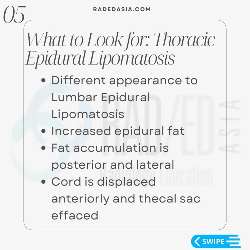 thoracic-epidural-lipomatosis- radiology-spine-spinal-mri-radedasia