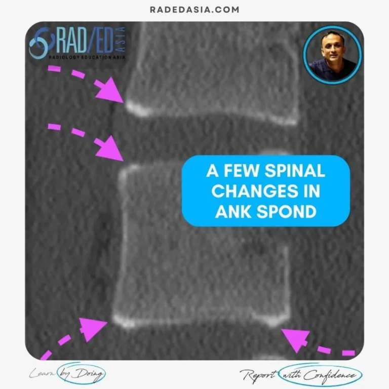 ankylosing spondylitis spine ct radiology