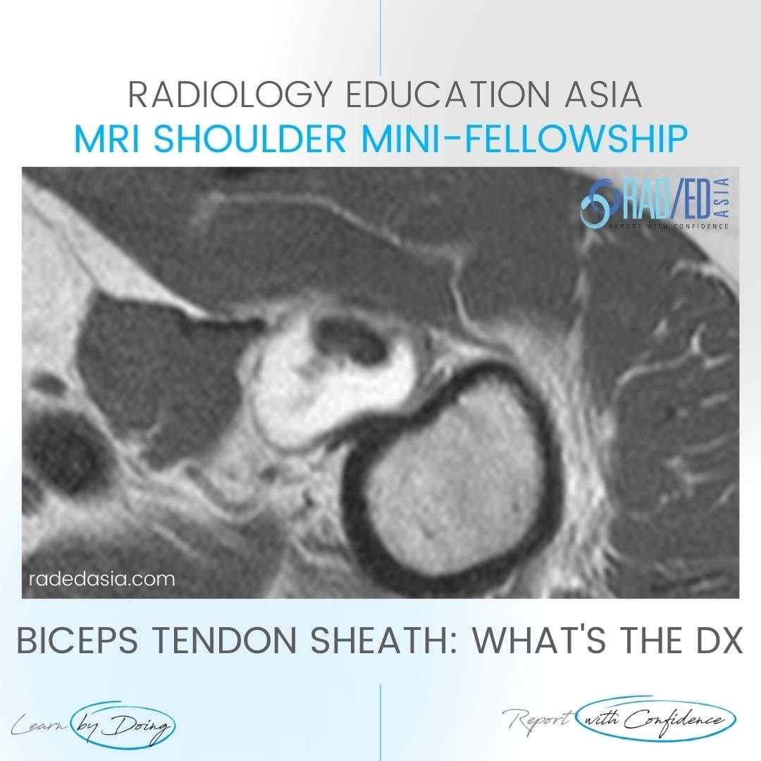 biceps-tenosynovitis-mri-tendon-sheath-effusion-tendinitis-tendonitis-radedasia.jpg