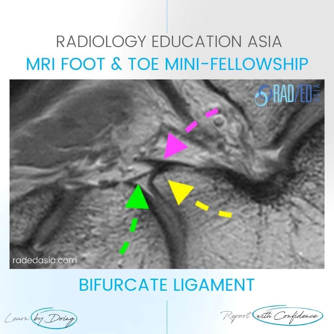 bifurcate-ligament-anterior-process-calcaneum-radiology-mri.jpg