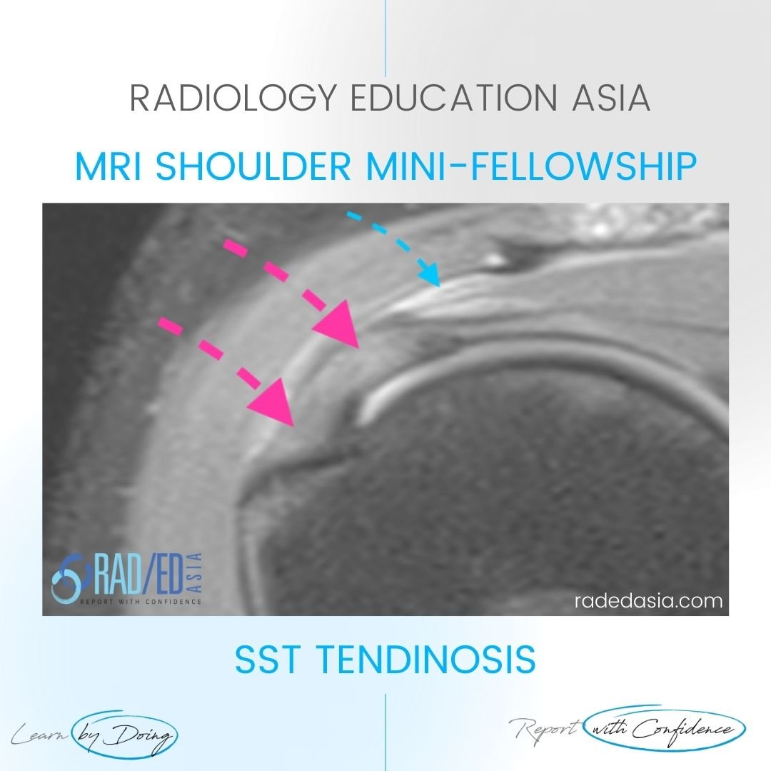 bursitis-rotator-cuff-tendinitis-mri-supraspinatus-tendinosis-radiology.jpg