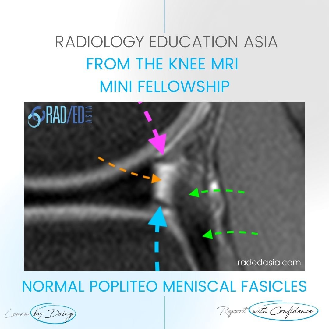 learn-knee-popliteomeniscal-fasicles-normal-diag-radedasia.jpg