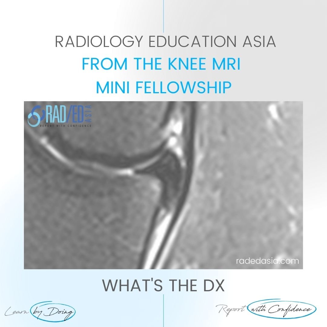 learn-mri-knee-meniscus-disp-flap-tear-wtd-radedasia.jpg