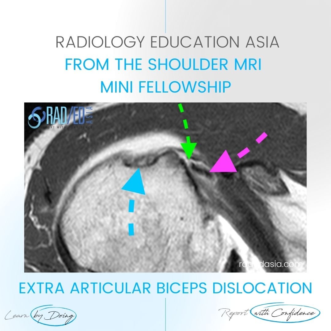 learn-shoulder-mri-biseps-disloc-cyst-diag-radedasia.jpg