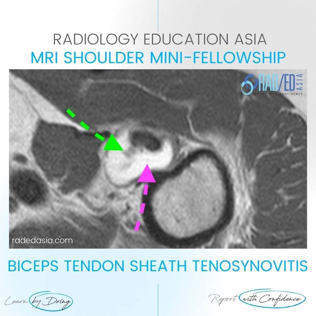 mri-biceps-tenosynovitis-tendon-sheath-effusion-tendinitis-tendonitis.jpg