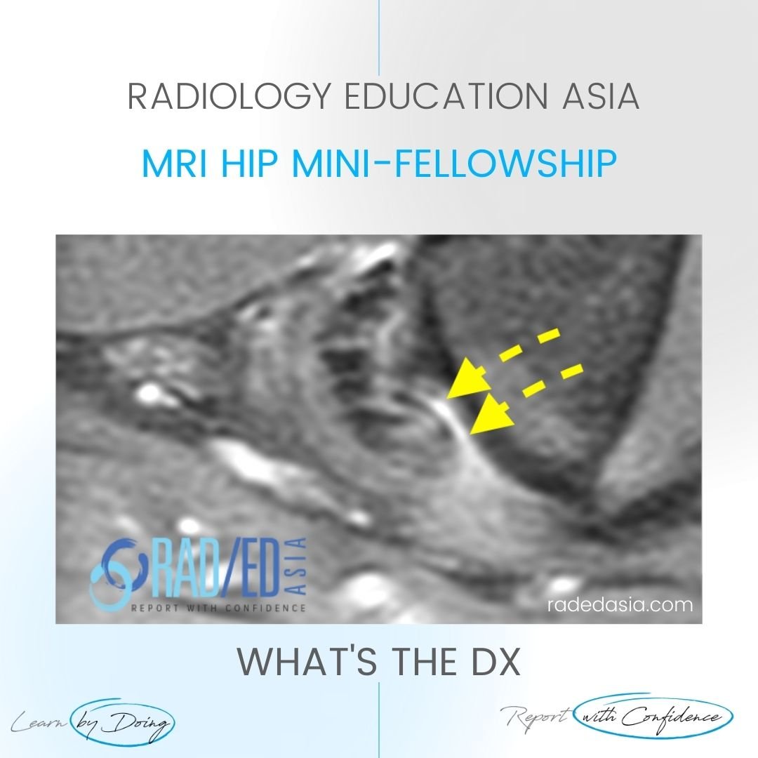 mri-hamstring-tear-tendinopathy-tendon-hip.jpg