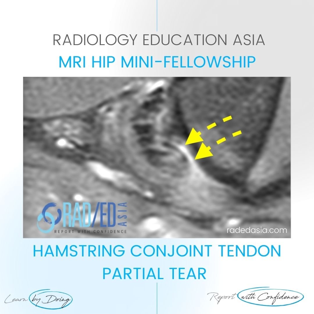 mri-hamstring-tendinopathy-tear-tendon-hip.jpg