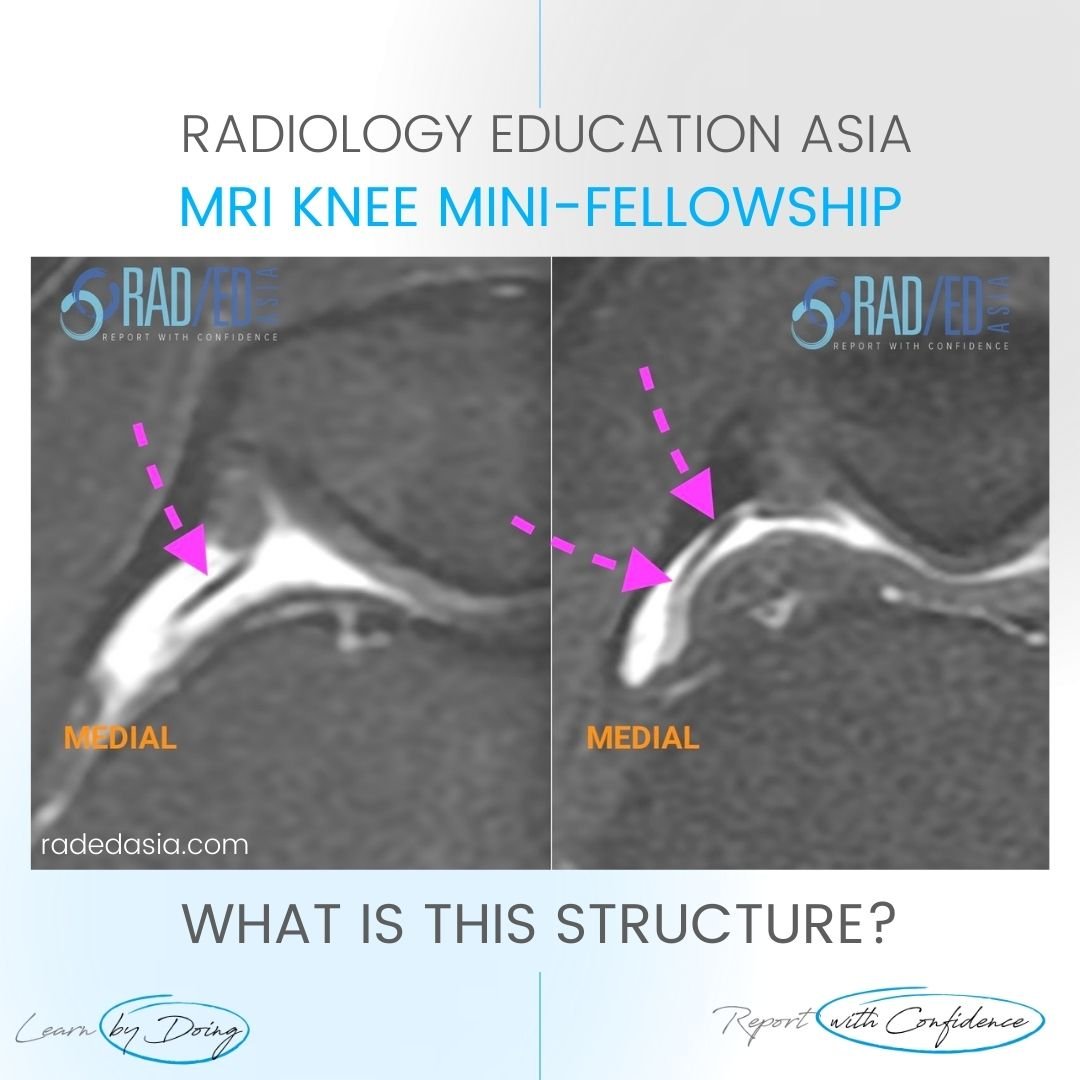 patella-plica-mri-radiology-syndrome-knee-medial-radedasia.jpg