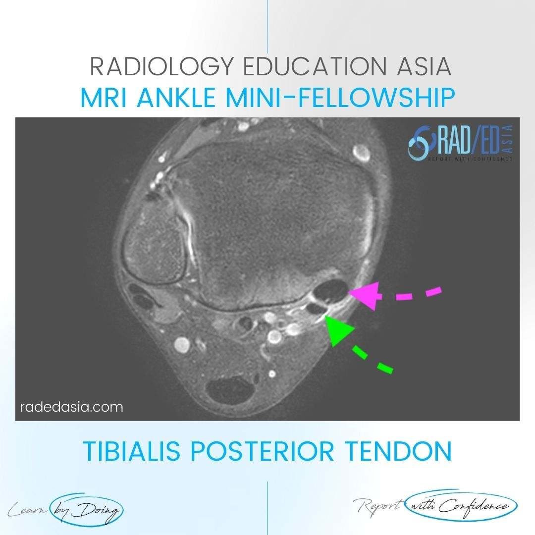 posterior-tibial-tendinopathy-mri-radiology-radedasia.jpg