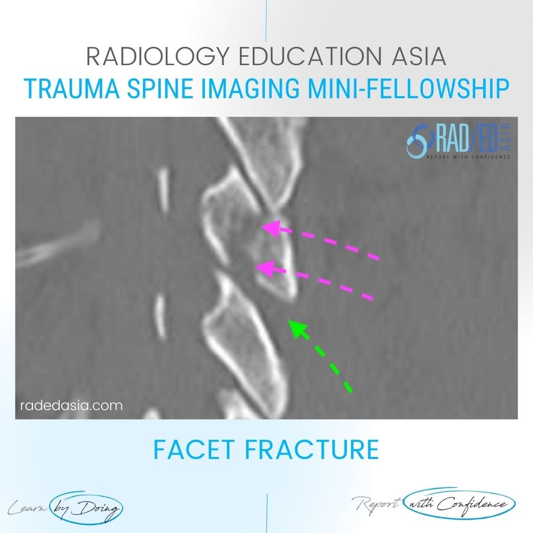 spine-trauma-imaging-facet-fracture-dislocation-ct-radiology.jpg