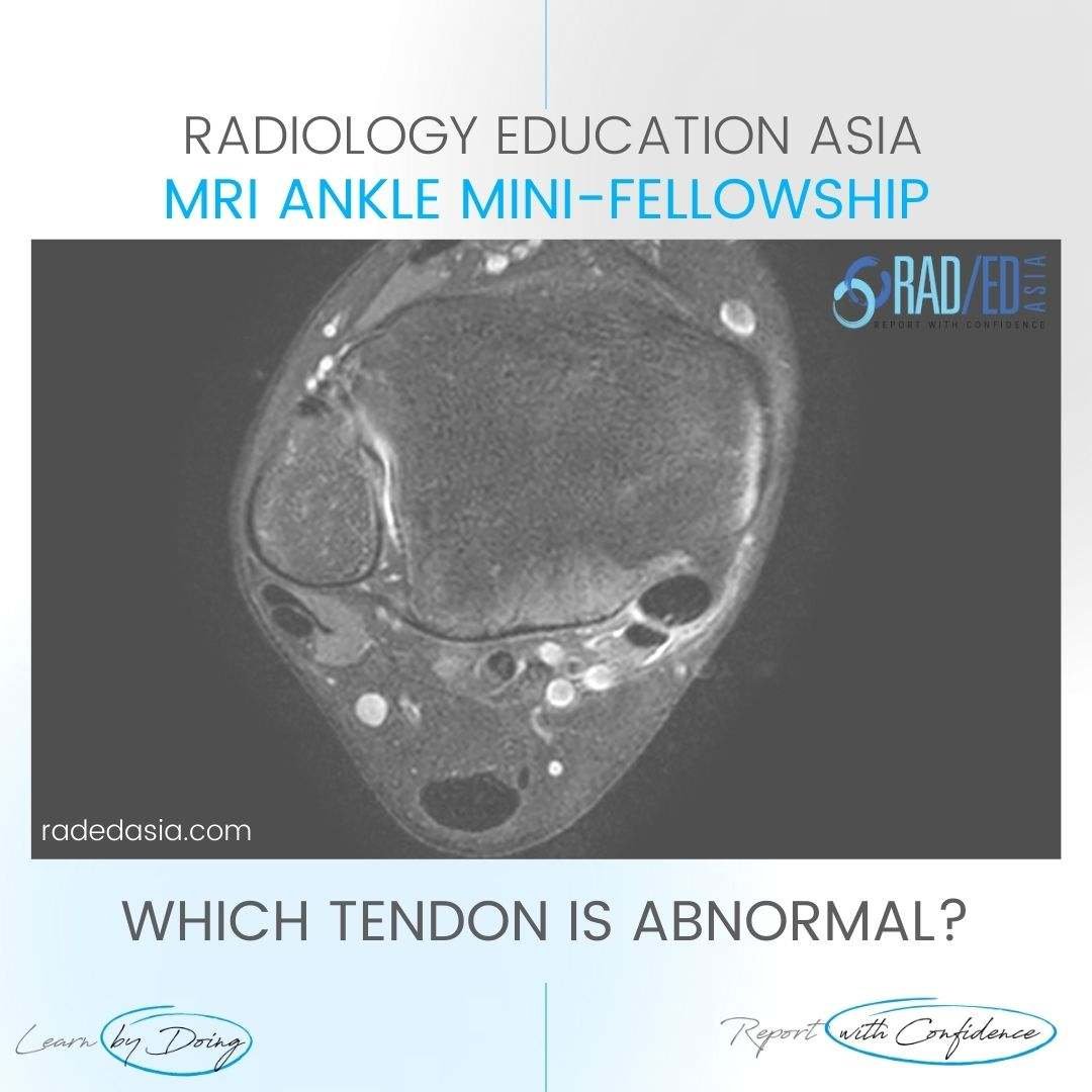 tibialis-posterior-tendinopathy-mri-radiology-radedasia.jpg